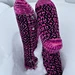 Martius pattern 